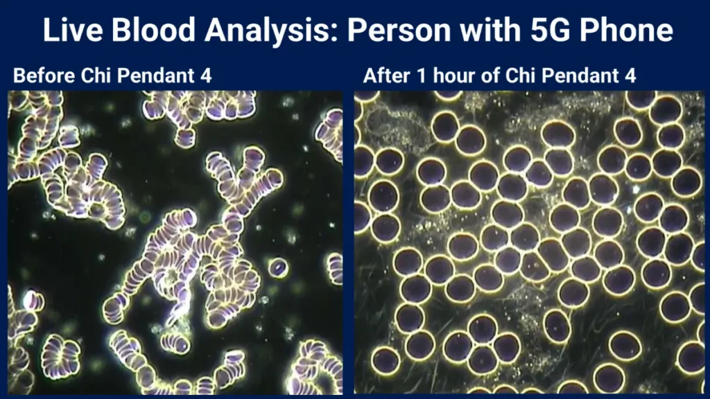 Amezcua Science: Live blood analysis of person with 5G phone, before and after using Chi Pendant 4